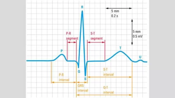Standard morphology of a cardiac electrical cycle